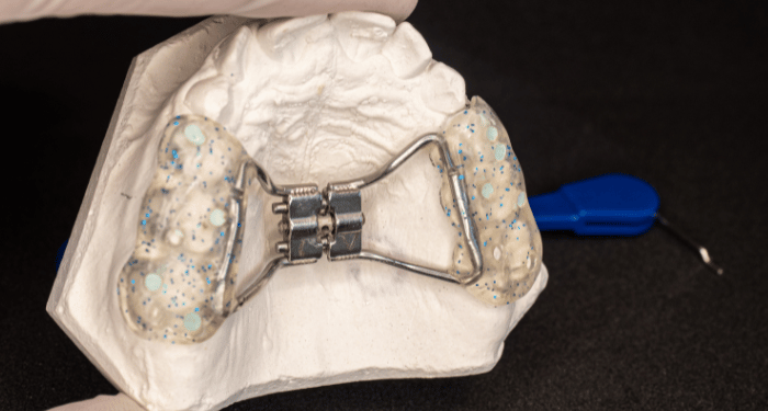 palatal expander and MARPE