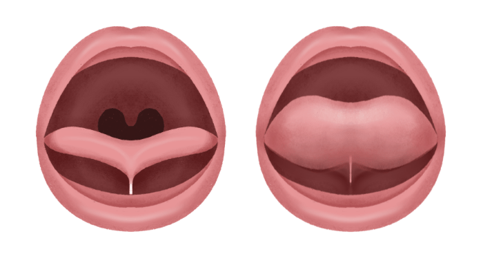 Tongue tie