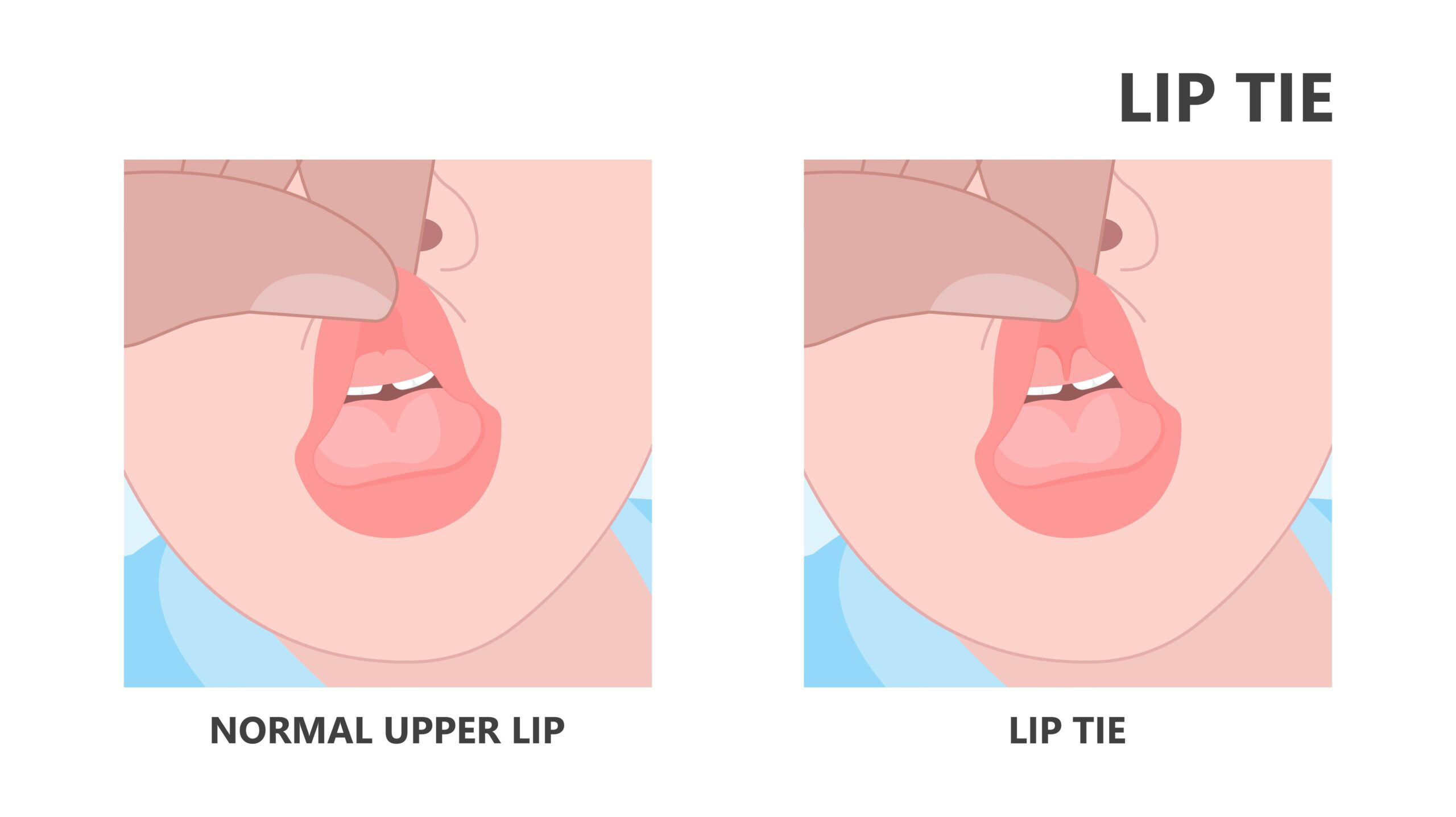 lip tie functional impact assessment